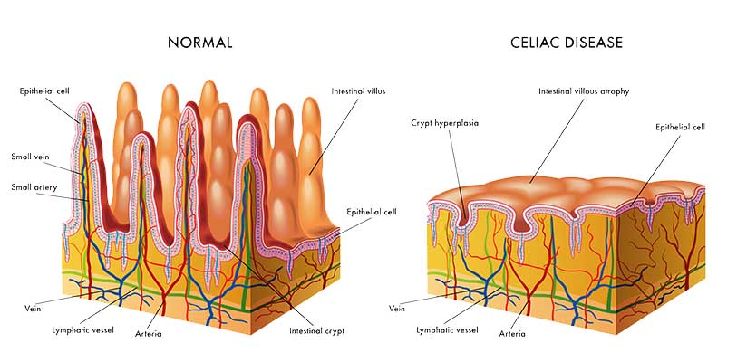 simptome celiachie intestin subtire